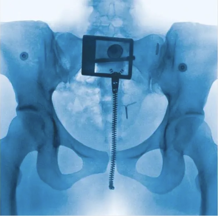 Virgin Lorde | Muse by Clios Blue-tinted pelvic X-ray showing orthopedic hardware: a long sacral screw with a square navigation frame fixed to the pelvis.